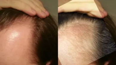 Zblýsknutí vlasů na čele s viditelnou pleťí hlavy.